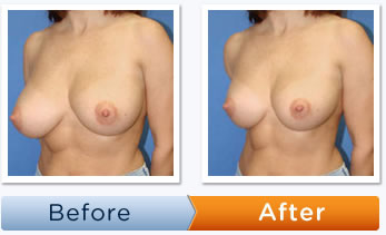 Breast Reduction Pictures By Size