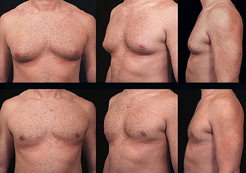 male reduction of cost breast