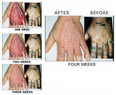 Surgical Tattoo Removal Procedures Tattoo Removal Surgery India,