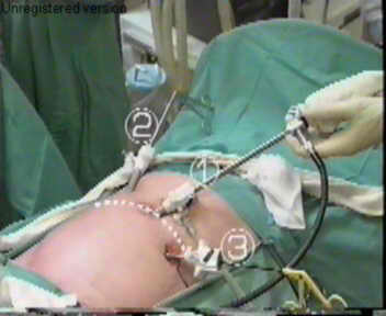 Hernia Patch Surgery