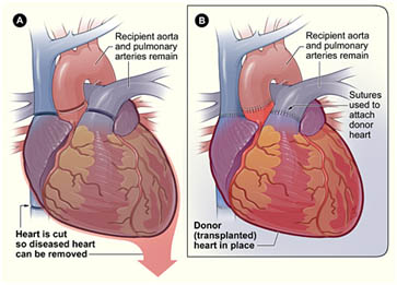 Heart transplant in India, Heart transplant cost in India, Heart transplant India