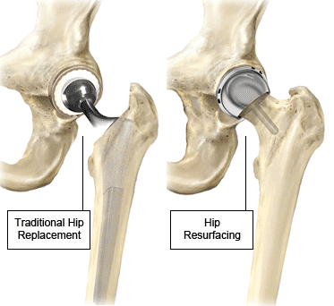 both-hip-replacement-together1.gif