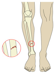 Orthopedic Knee Surgery in India