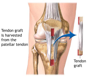 ACL Reconstruction Surgery India, Cost ACL Reconstruction Surgery Delhi, ACL Reconstruction Surgery Cost India Delhi, Anterior Cruciate Ligament (ACL) Reconstruction, ACL Surgery, ACL Rehabilitation, Knee Injury, Knee Surgery, Meniscal Tears