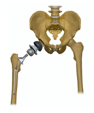 Both Hip Replacement Surgery Together India, Price Hip Replacement India, Hip Joint, Operation, Description, Recovery, Complications, Hip Joint Replacement, Rehab, Problems, Fractured Hip, Hip Replacement Superspeciality Clinic Goa India
