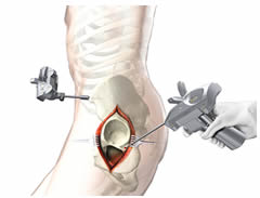 Cost Hip Replacement, Computer Navigation India, Computer Navigation Assisted Hip Replacement India