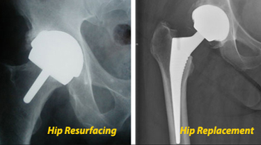 Hip Resurfacing Surgery India, Cost Hip Resurfacing Surgery Delhi India, Hip Resurfacing, Birmingham Hip Resurfacing, Hip Replacement