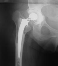 Revision Hip Replacement Surgery India, Cost Revision Hip Replacement, Orthopedic Procedures, Total Hip And Knee Replacement, Complications Of Treatment, Revision Hip Replacement Surgery Medication