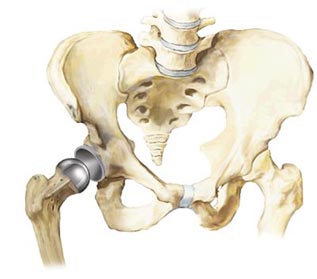 Revision Hip Replacement Surgery India, Cost Revision Hip Replacement, Revision Hip Replacement Cost India, Orthopedic Procedures, Total Hip And Knee Replacement, Complications Of Treatment, Revision Hip Replacement Surgery Medication