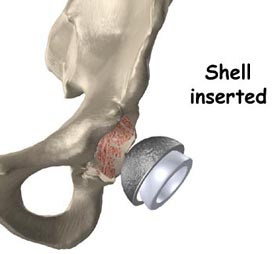 Uncemented Total Hip Replacement Surgery India, Uncemented Hip Replacement India, Total Hip Arthroplasty, Uncemented Total Hip Arthroplasty, Best Price Uncemented Hip Replacement Surgery